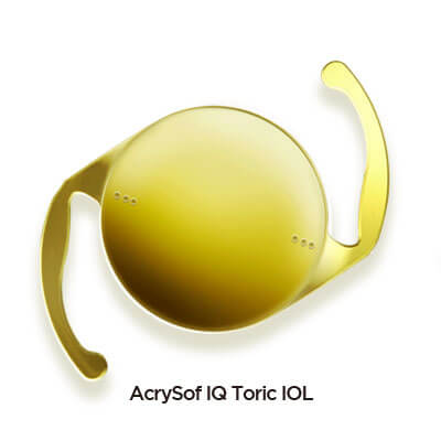 백내장 난시 수술