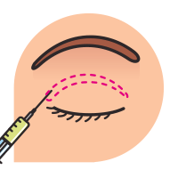 blepharoplasty-prss-2