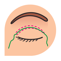 blepharoplasty-prss-3