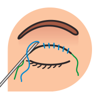 blepharoplasty-prss-4