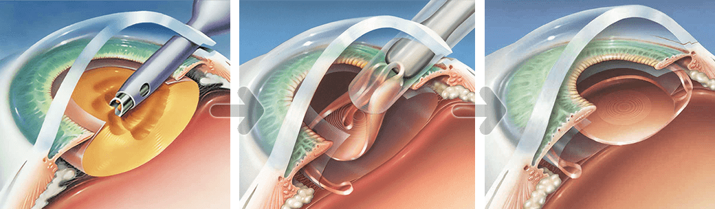 백내장수술과정