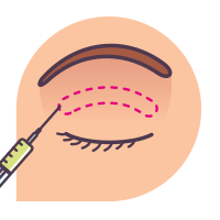 쌍꺼풀 성형 쌍꺼풀 성형