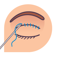 쌍꺼풀 성형 쌍꺼풀 성형