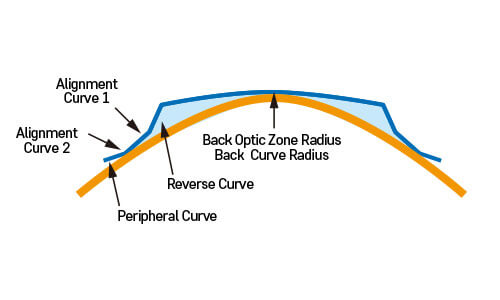 드림렌즈의 구조 드림렌즈