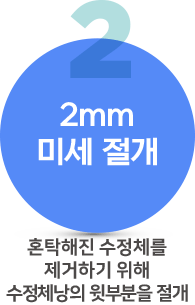 백내장수술과정2 백내장수술과정